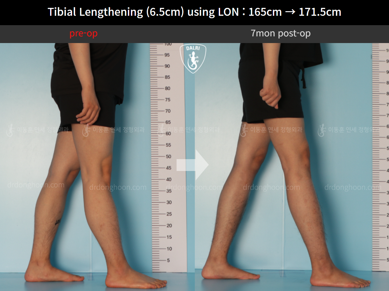 Before and after cll lon, case 10388000, image 7, Dr. Donghoon institute (DALRI)