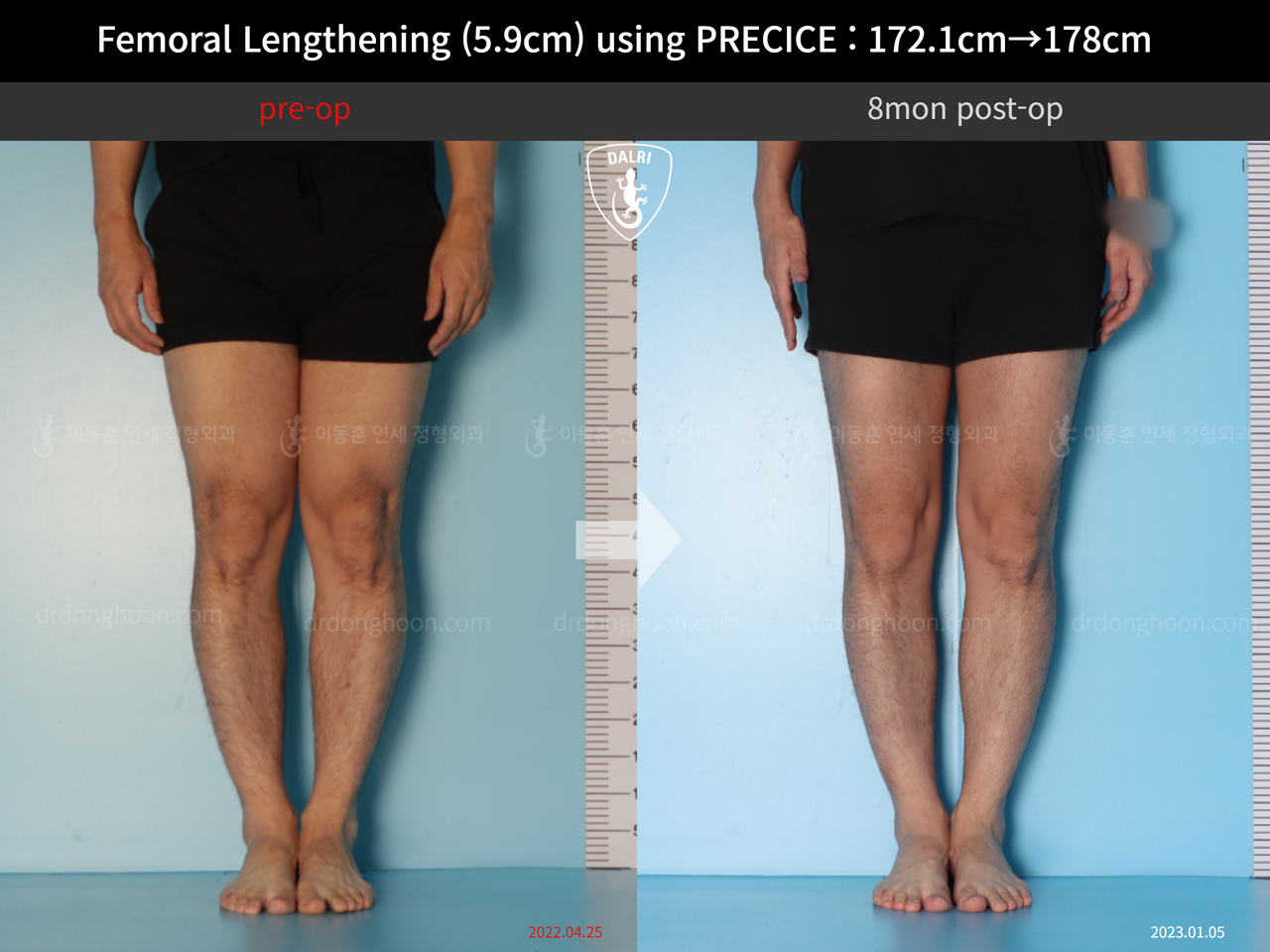 Before and after cll precice, case 13848850, image 8, Dr. Donghoon institute (DALRI)