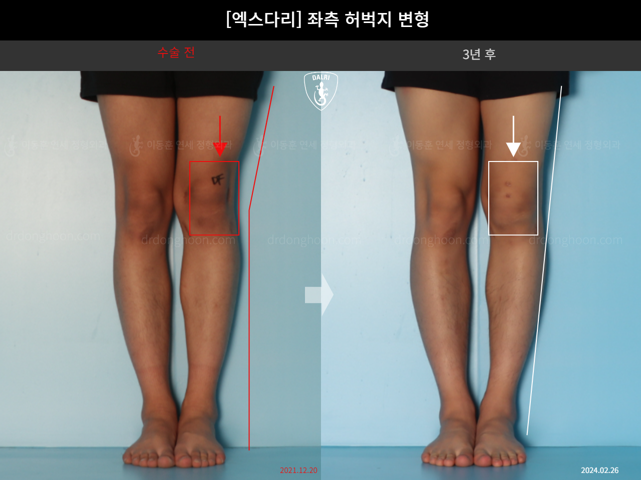 Before and after adult knock knees, case 18261918, image 5, Dr. Donghoon institute (DALRI)