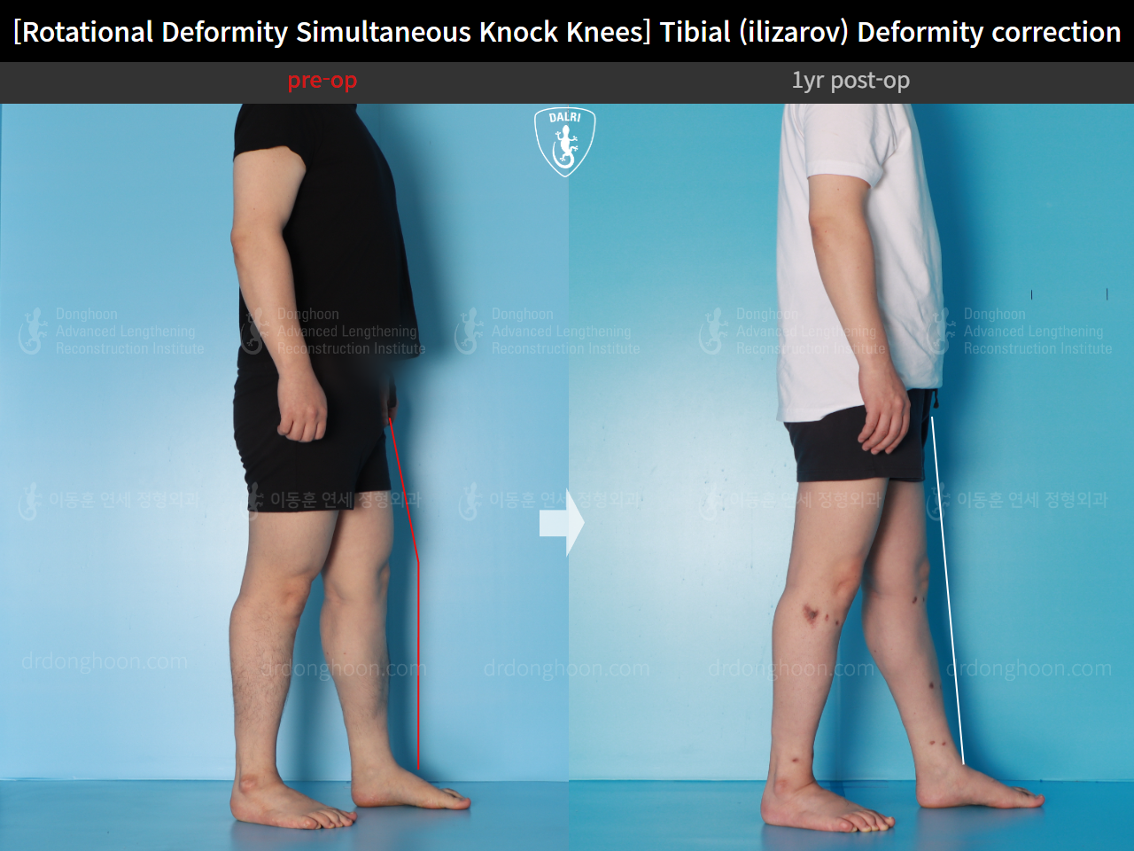 Before and after adult knock knees, case 15977455, image 4, Dr. Donghoon institute (DALRI)