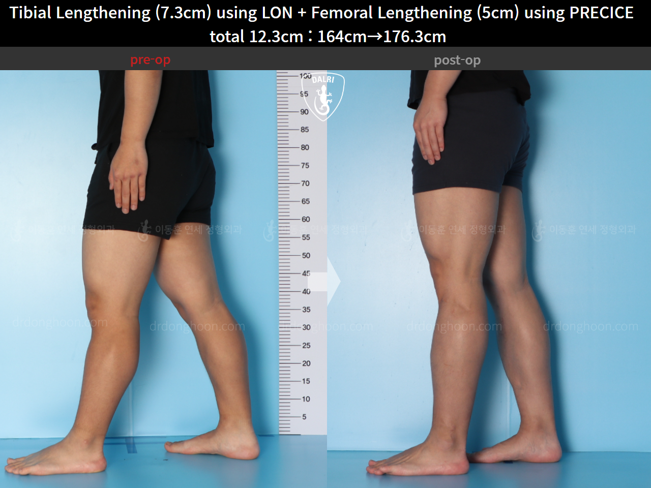 Before and after cll lon, case 15592729, image 8, Dr. Donghoon institute (DALRI)