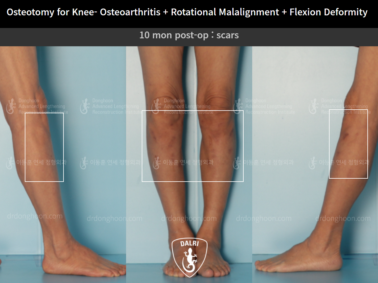 Before and after adult bowlegs, case 9128510, image 7, Dr. Donghoon institute (DALRI)
