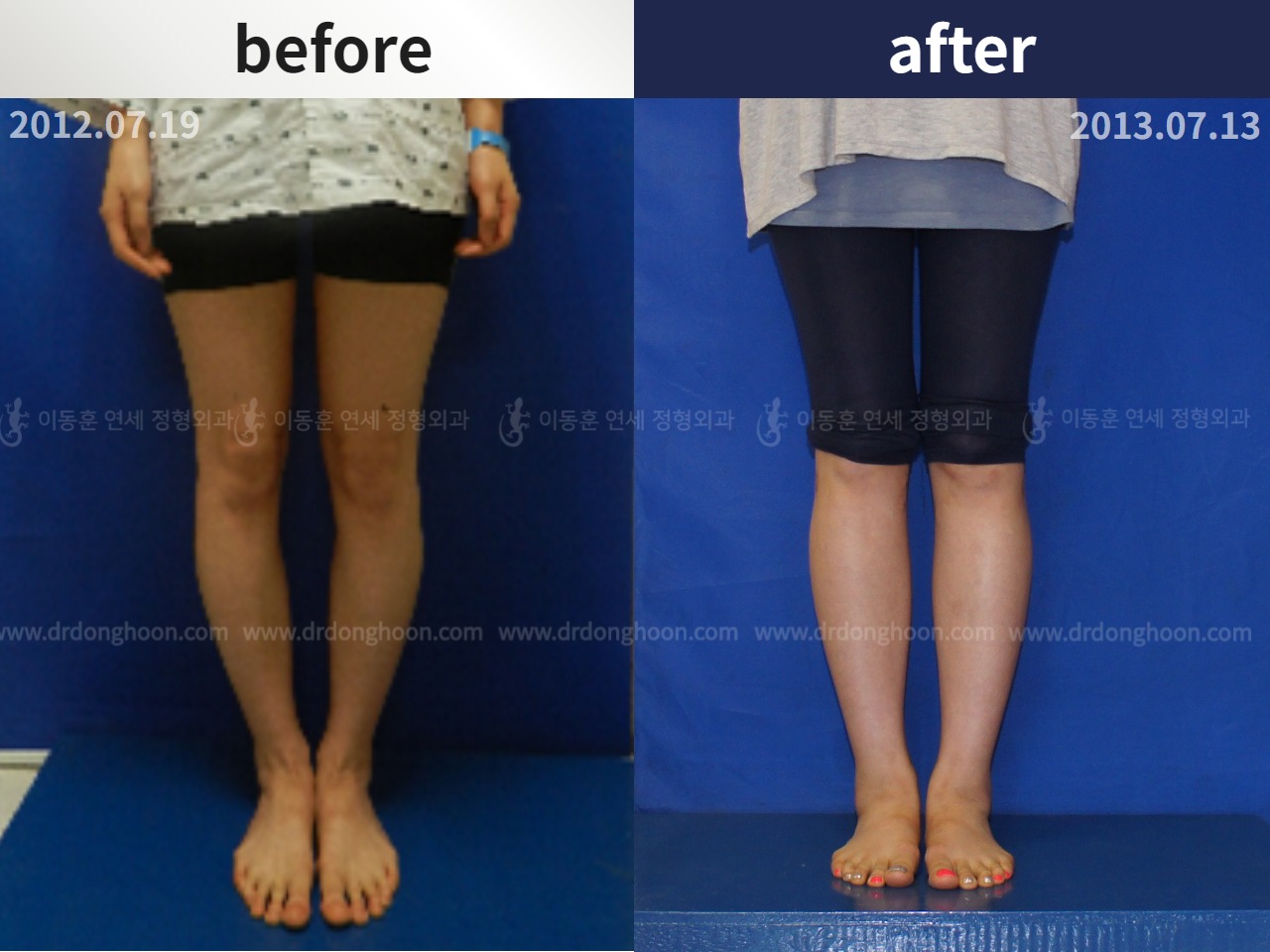 Before and after adult bowlegs, case 4311080, image 1, Dr. Donghoon institute (DALRI)