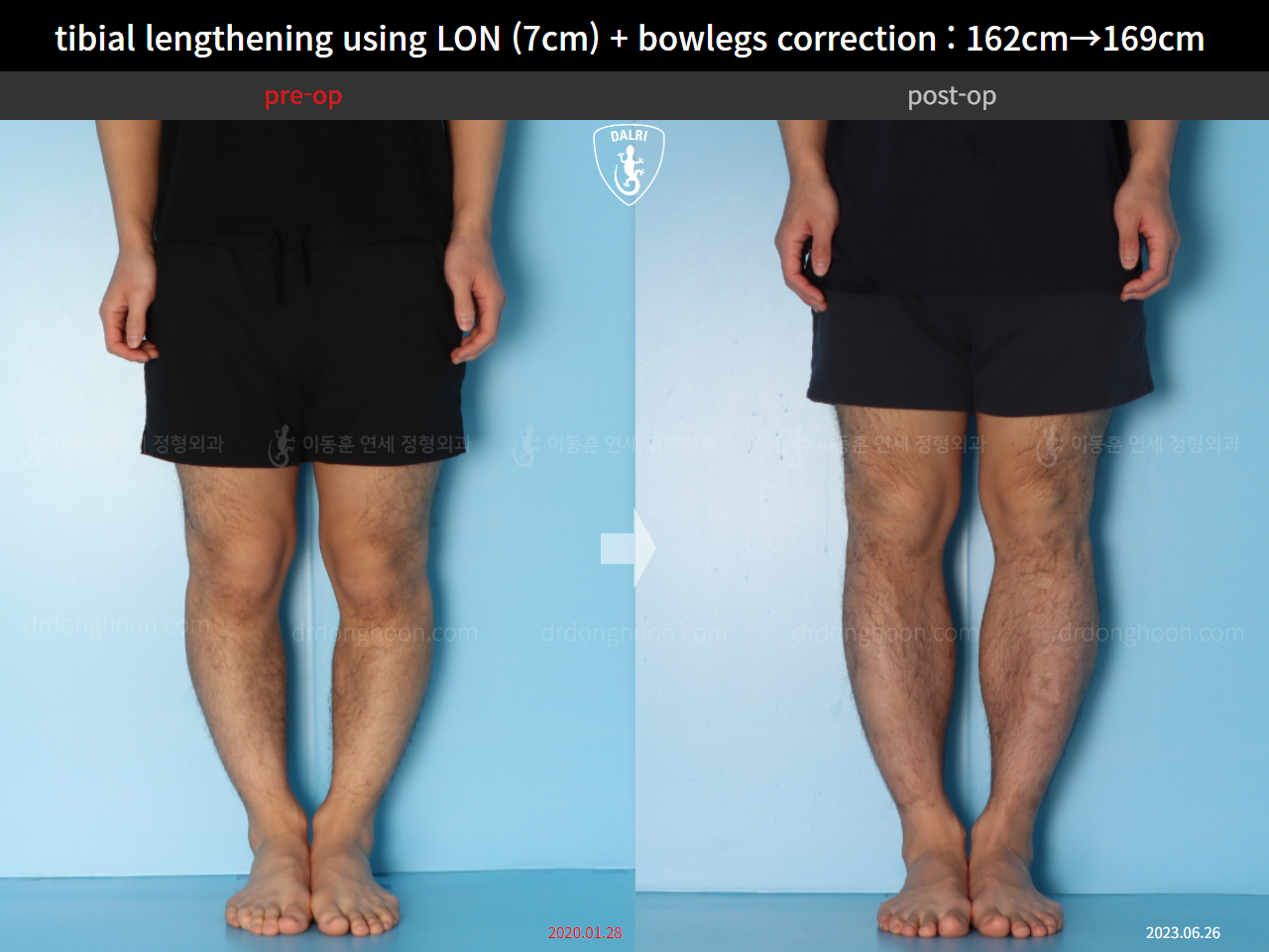 Before and after cll + deformity correction, case 15545055, image 5, Dr. Donghoon institute (DALRI)