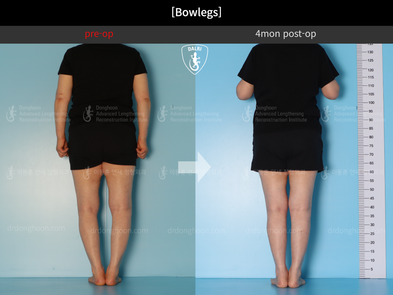 Before and after adult bowlegs, case 12586483, image 4, Dr. Donghoon institute (DALRI)