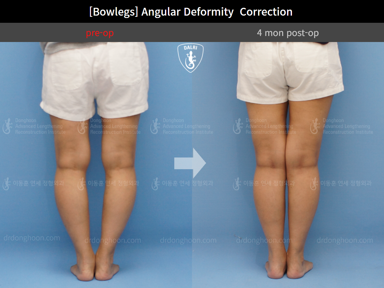 Before and after adult bowlegs, case 9289009, image 7, Dr. Donghoon institute (DALRI)