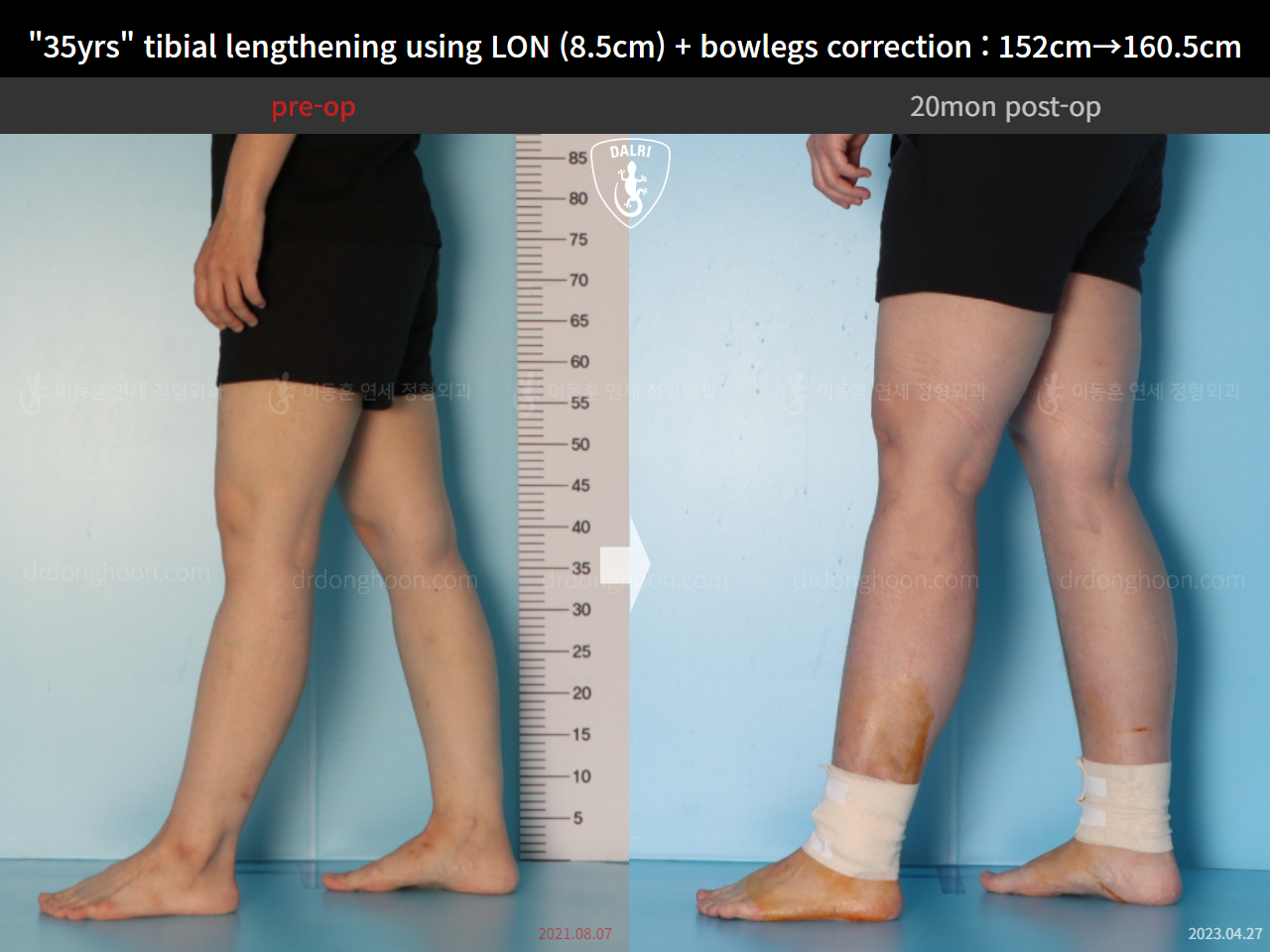 Before and after cll lon, case 15036651, image 9, Dr. Donghoon institute (DALRI)