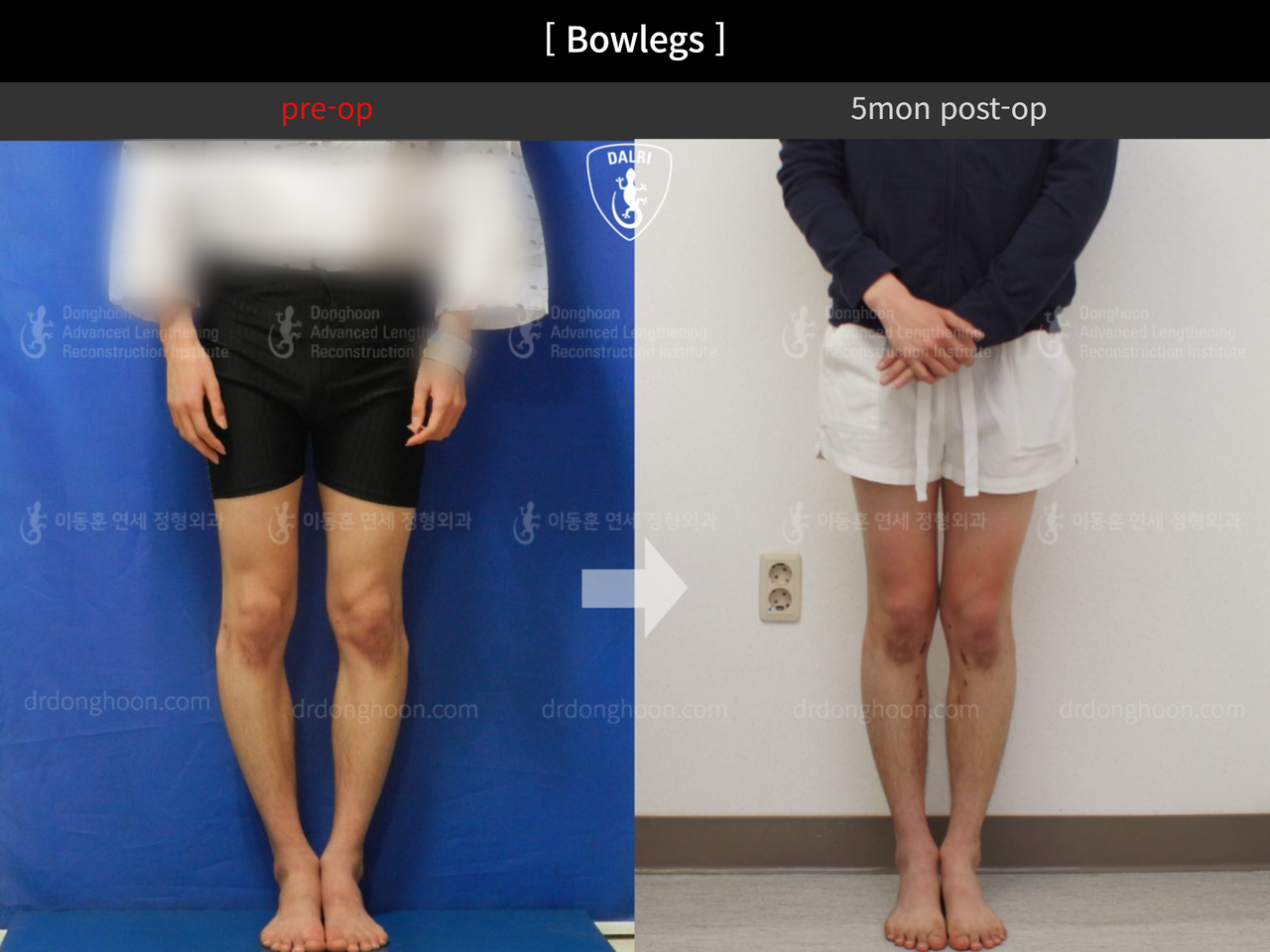 Before and after adult bowlegs, case 12756537, image 2, Dr. Donghoon institute (DALRI)