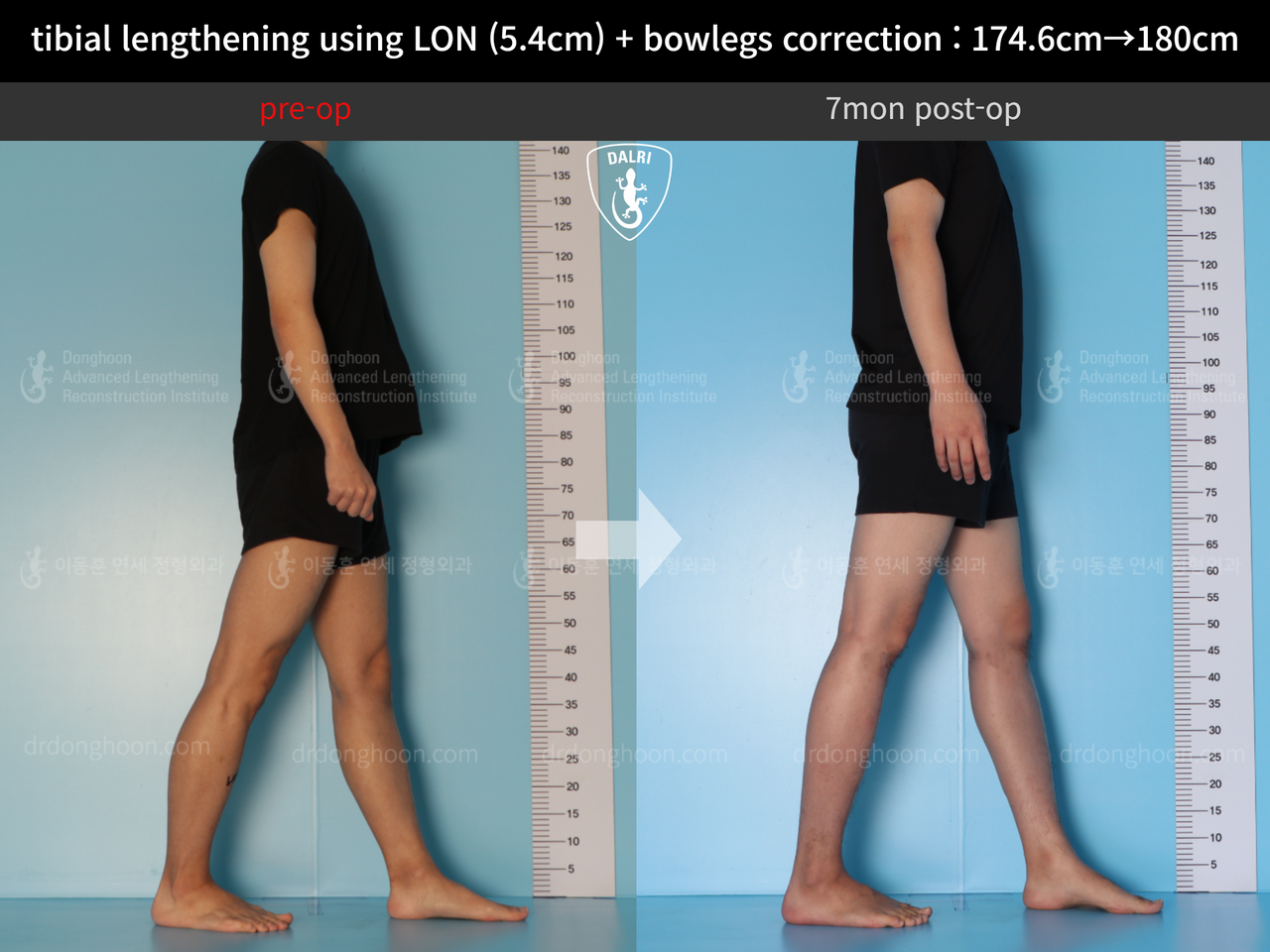 Before and after cll + deformity correction, case 12718558, image 5, Dr. Donghoon institute (DALRI)