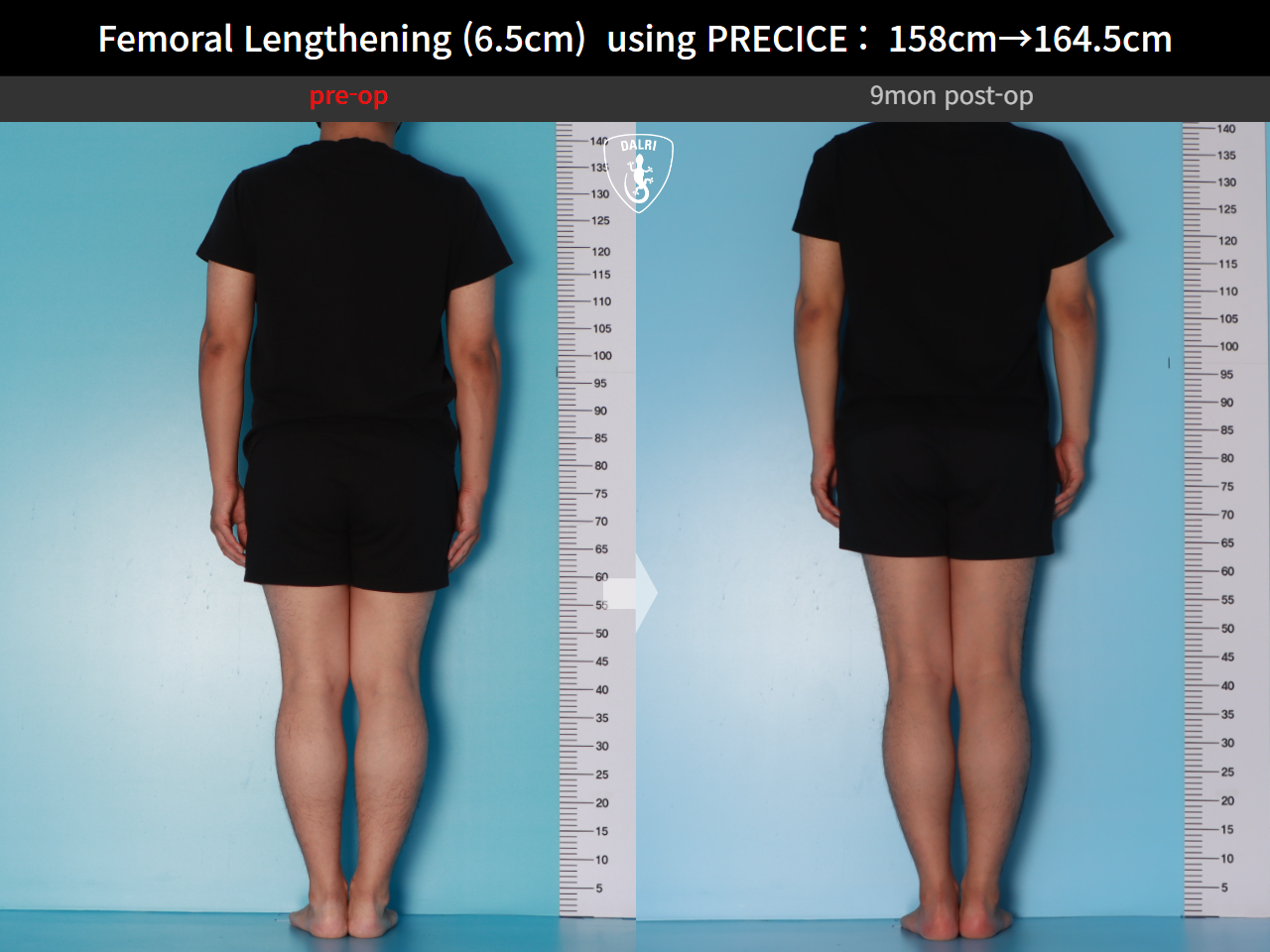 Before and after cll precice, case 28297898, image 2, Dr. Donghoon institute (DALRI)