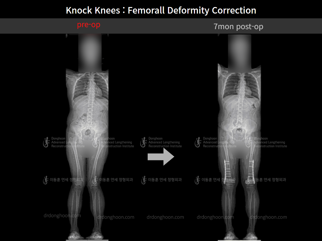 Before and after adult knock knees, case 8821218, image 6, Dr. Donghoon institute (DALRI)