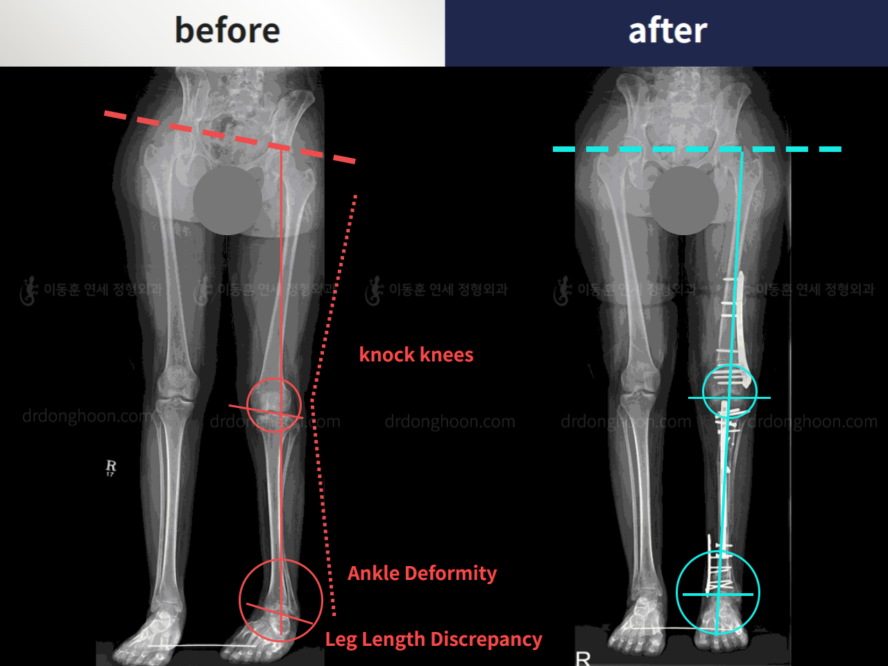Before and after complex deformity, case 4795338, image 3, Dr. Donghoon institute (DALRI)