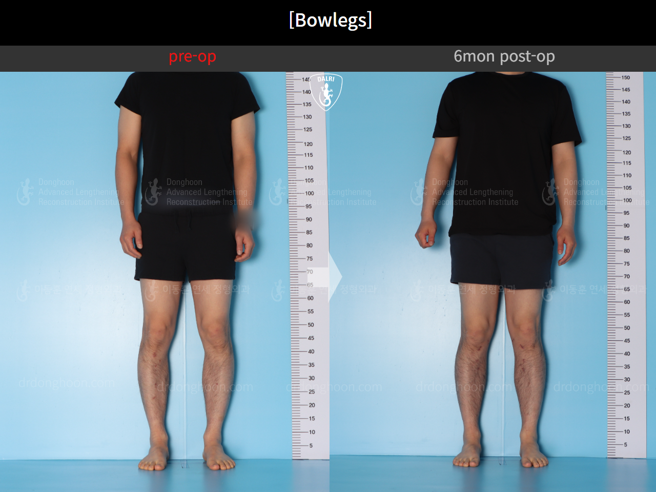 Before and after adult bowlegs, case 14742489, image 3, Dr. Donghoon institute (DALRI)