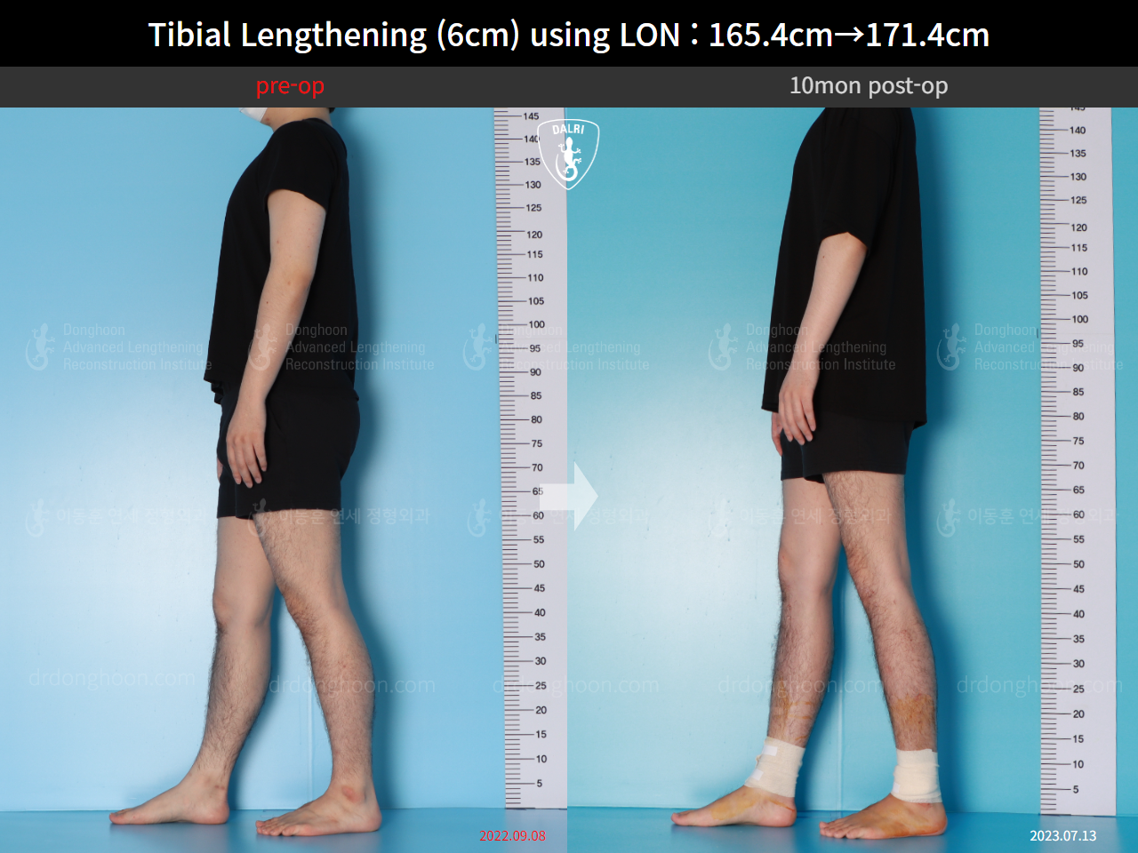 Before and after cll lon, case 15716525, image 6, Dr. Donghoon institute (DALRI)