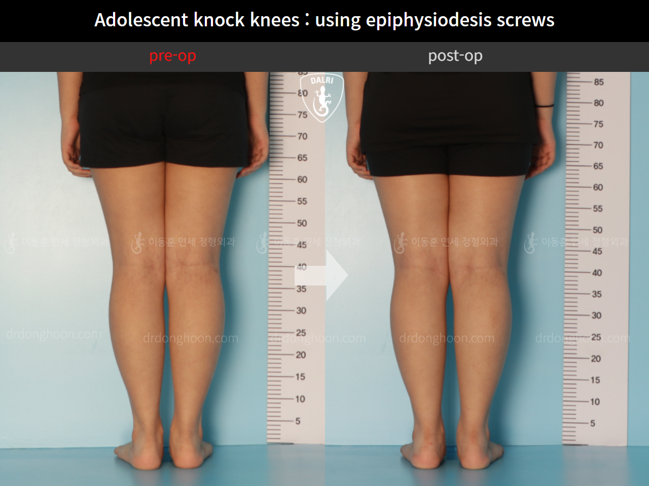 Before and after paediatric & adolescent knock knees, case 11123118, image 6, Dr. Donghoon institute (DALRI)