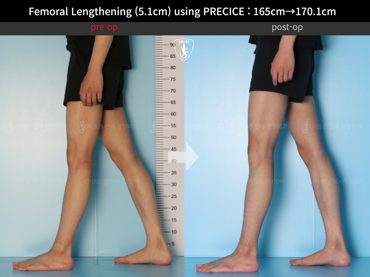 Before and after cll precice, case 13184743, image 8, Dr. Donghoon institute (DALRI)