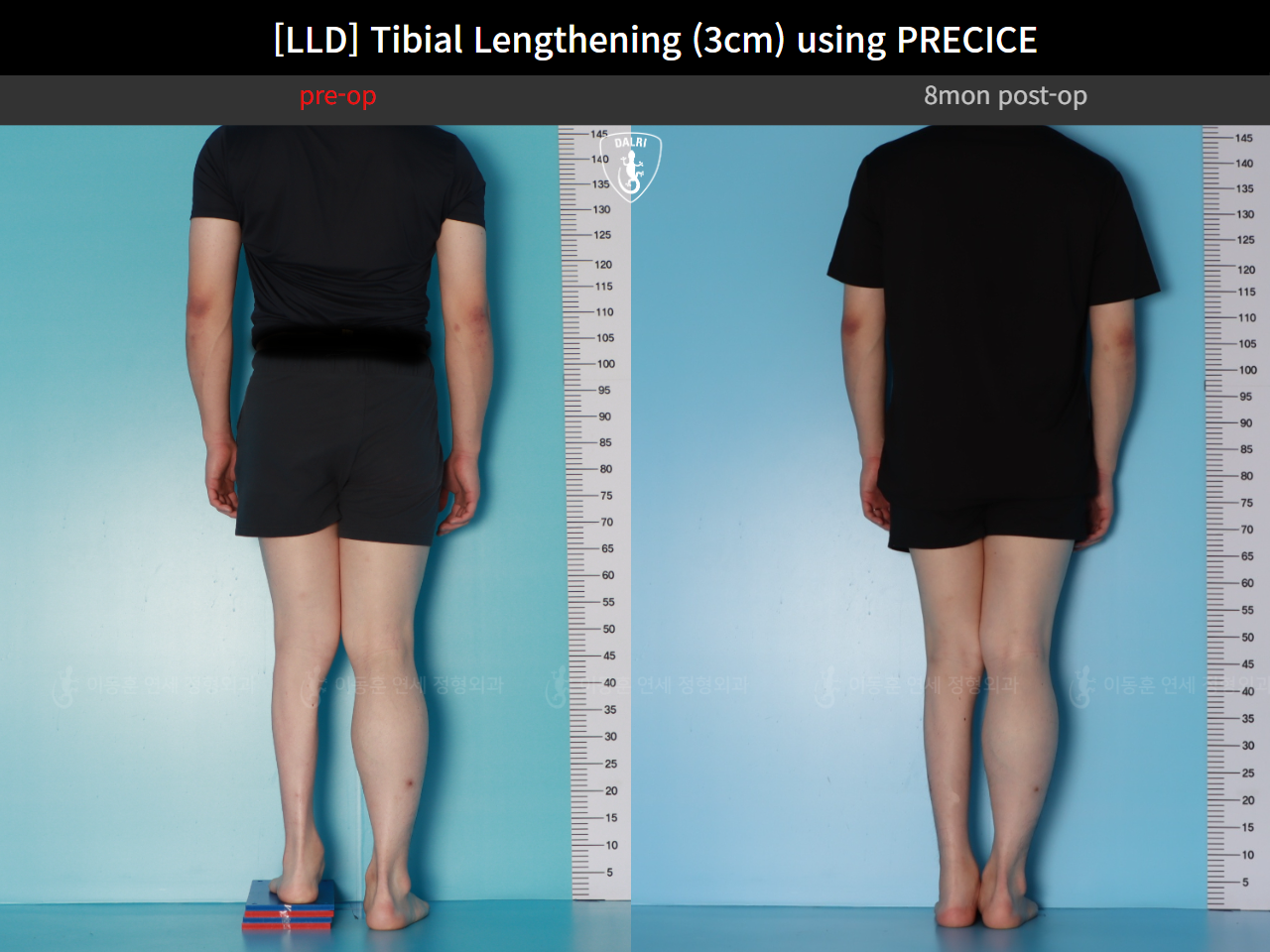 Before and after adult lld, case 124813877, image 2, Dr. Donghoon institute (DALRI)