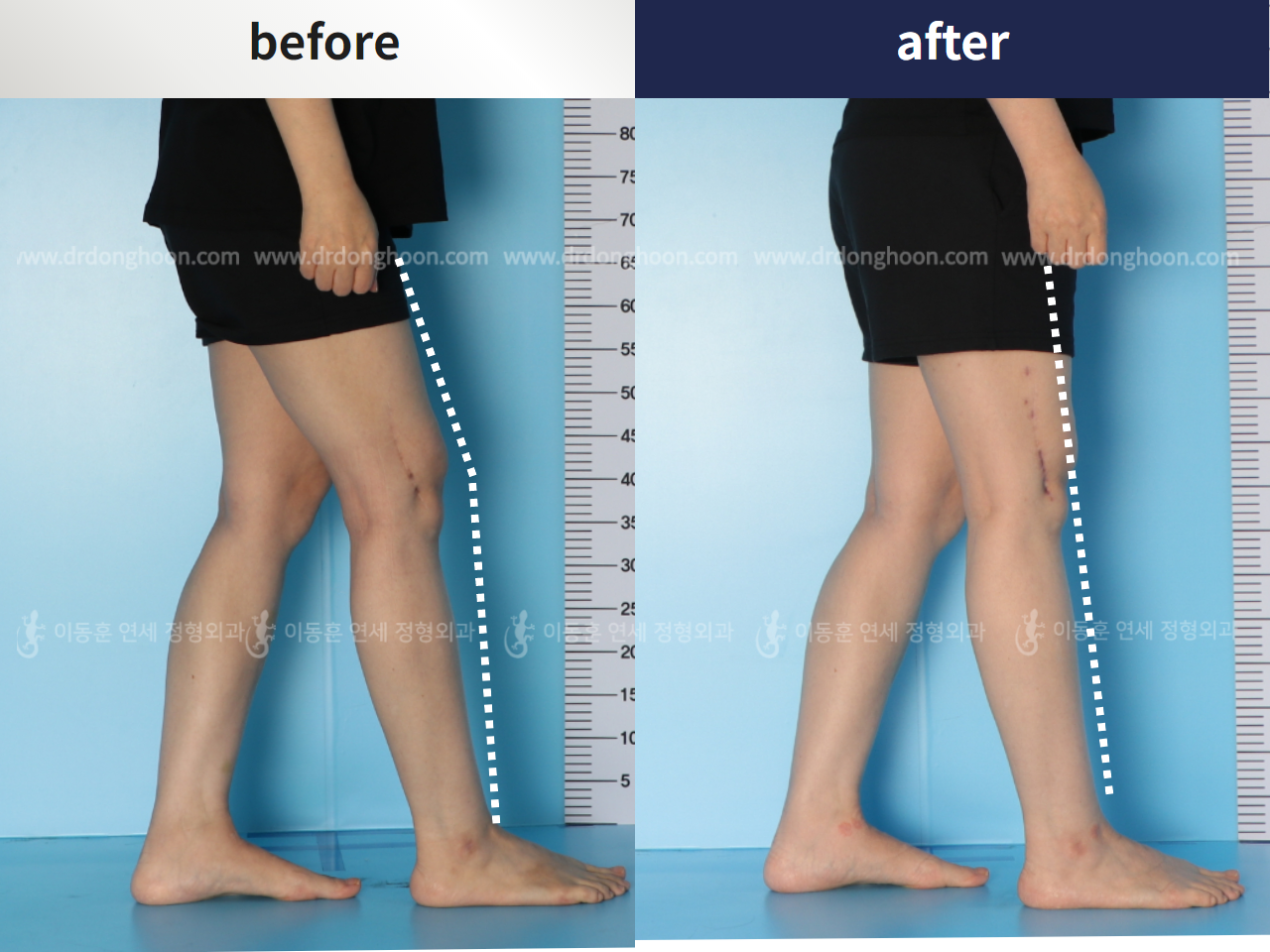 Before and after flexion deformity, case 4251743, image 1, Dr. Donghoon institute (DALRI)