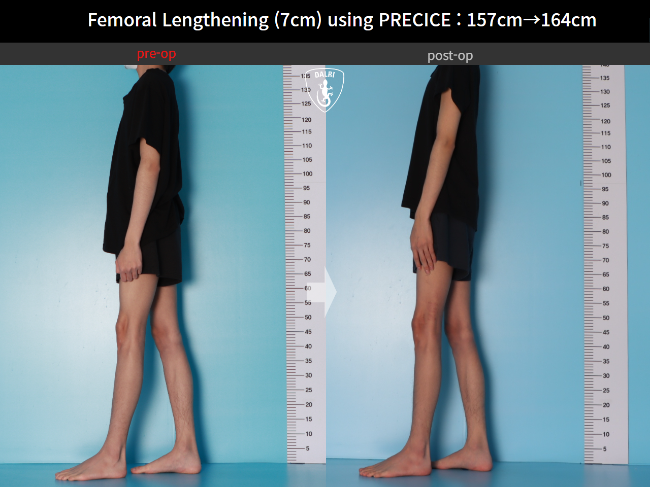 Before and after cll precice, case 31554406, image 3, Dr. Donghoon institute (DALRI)
