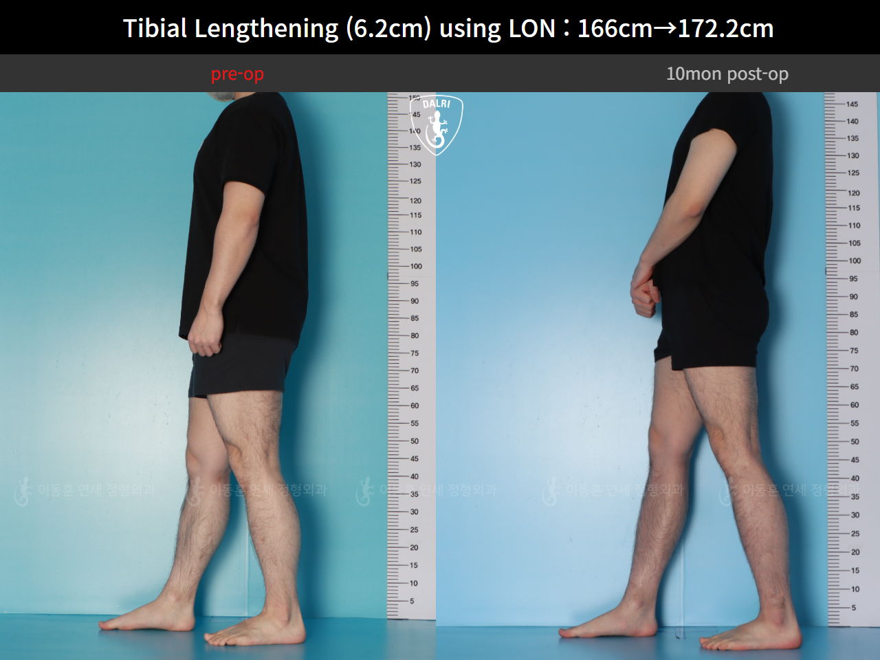 Before and after cll lon, case 128591201, image 6, Dr. Donghoon institute (DALRI)