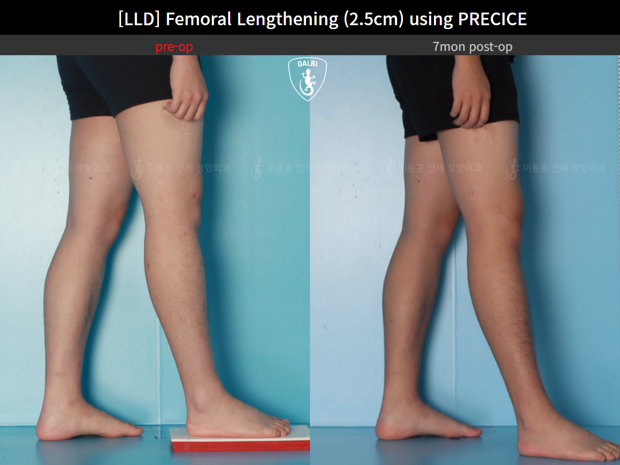 Before and after adult lld, case 127180202, image 7, Dr. Donghoon institute (DALRI)
