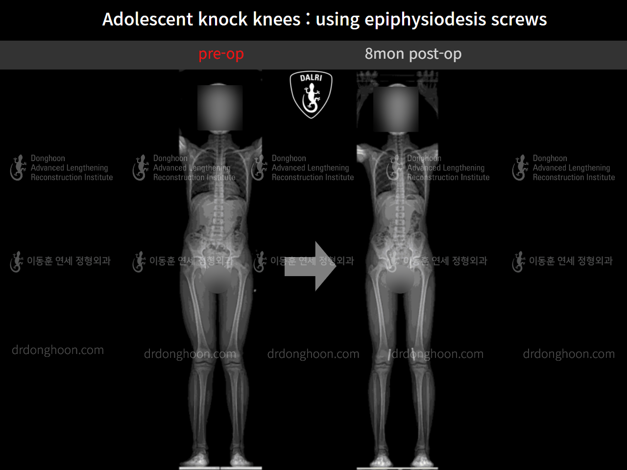Before and after paediatric & adolescent knock knees, case 10171145, image 8, Dr. Donghoon institute (DALRI)