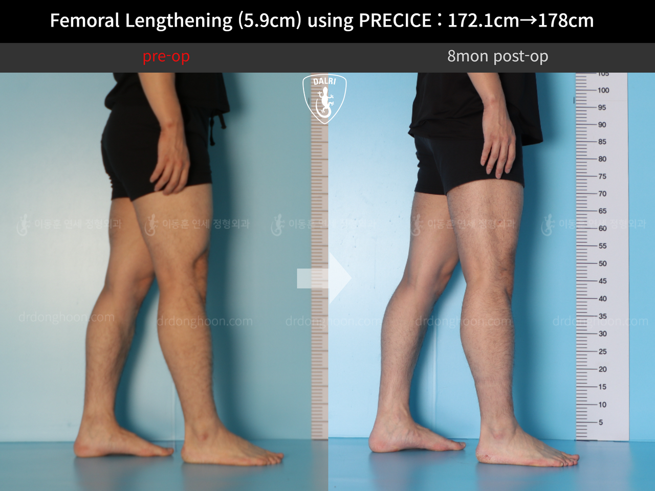 Before and after cll precice, case 13848850, image 11, Dr. Donghoon institute (DALRI)