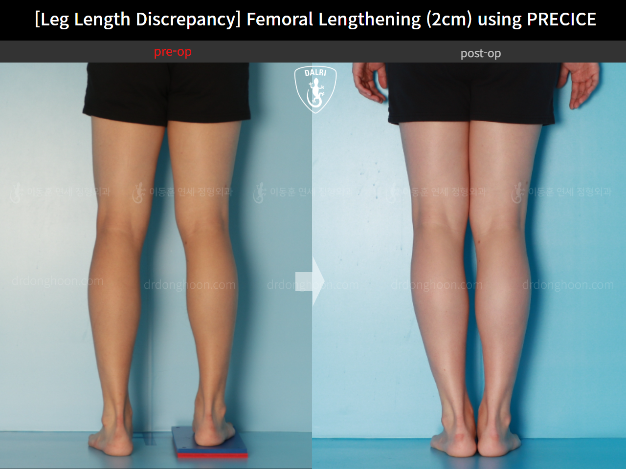Before and after adult lld, case 16061128, image 7, Dr. Donghoon institute (DALRI)