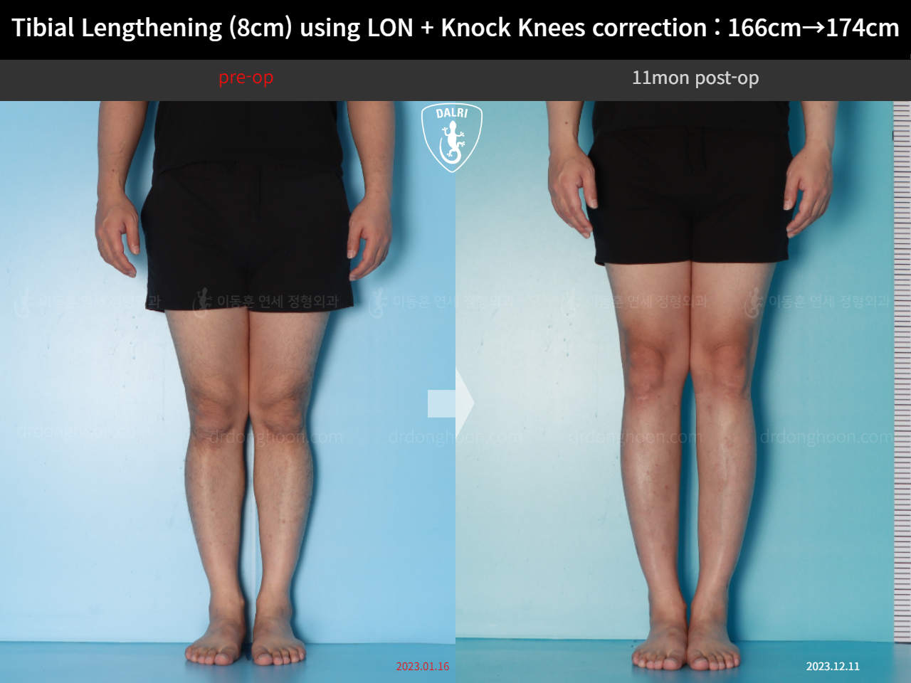 Before and after cll + deformity correction, case 20789954, image 7, Dr. Donghoon institute (DALRI)