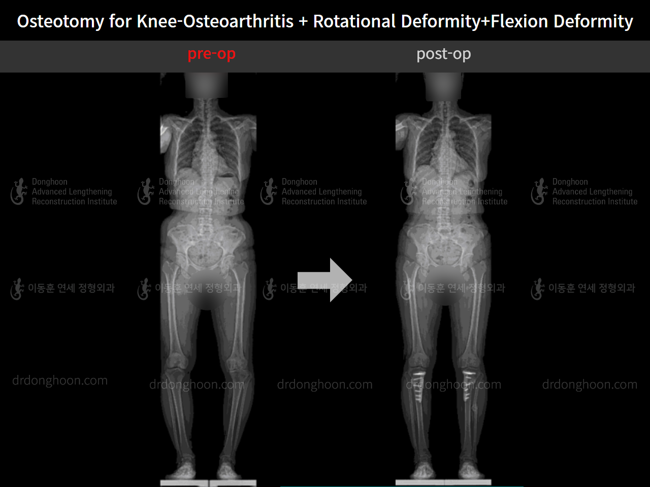 Before and after osteotomy for knee osteoarthritis, case 5987662, image 7, Dr. Donghoon institute (DALRI)