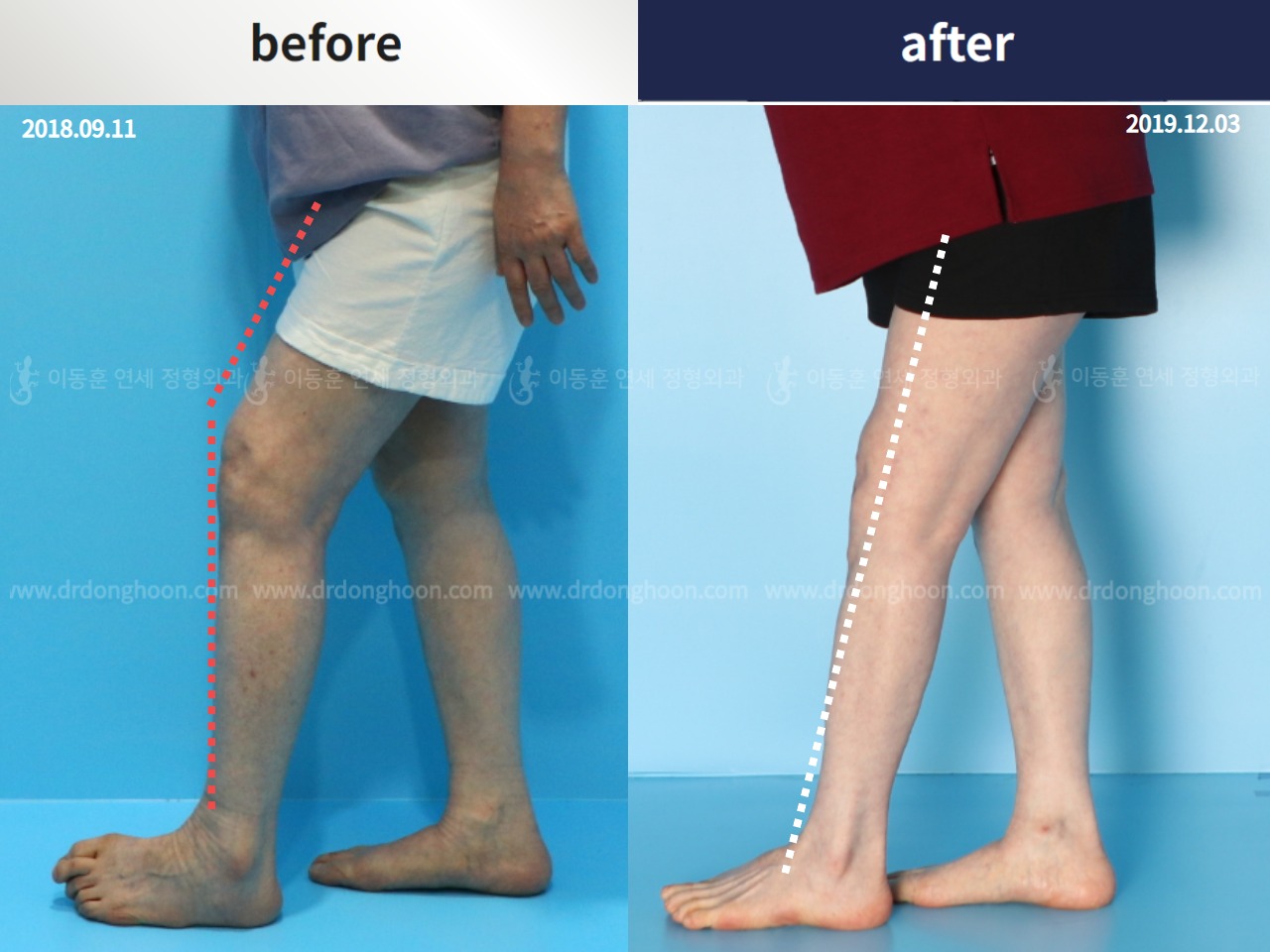 Before and after osteotomy for knee osteoarthritis, case 4306452, image 3, Dr. Donghoon institute (DALRI)