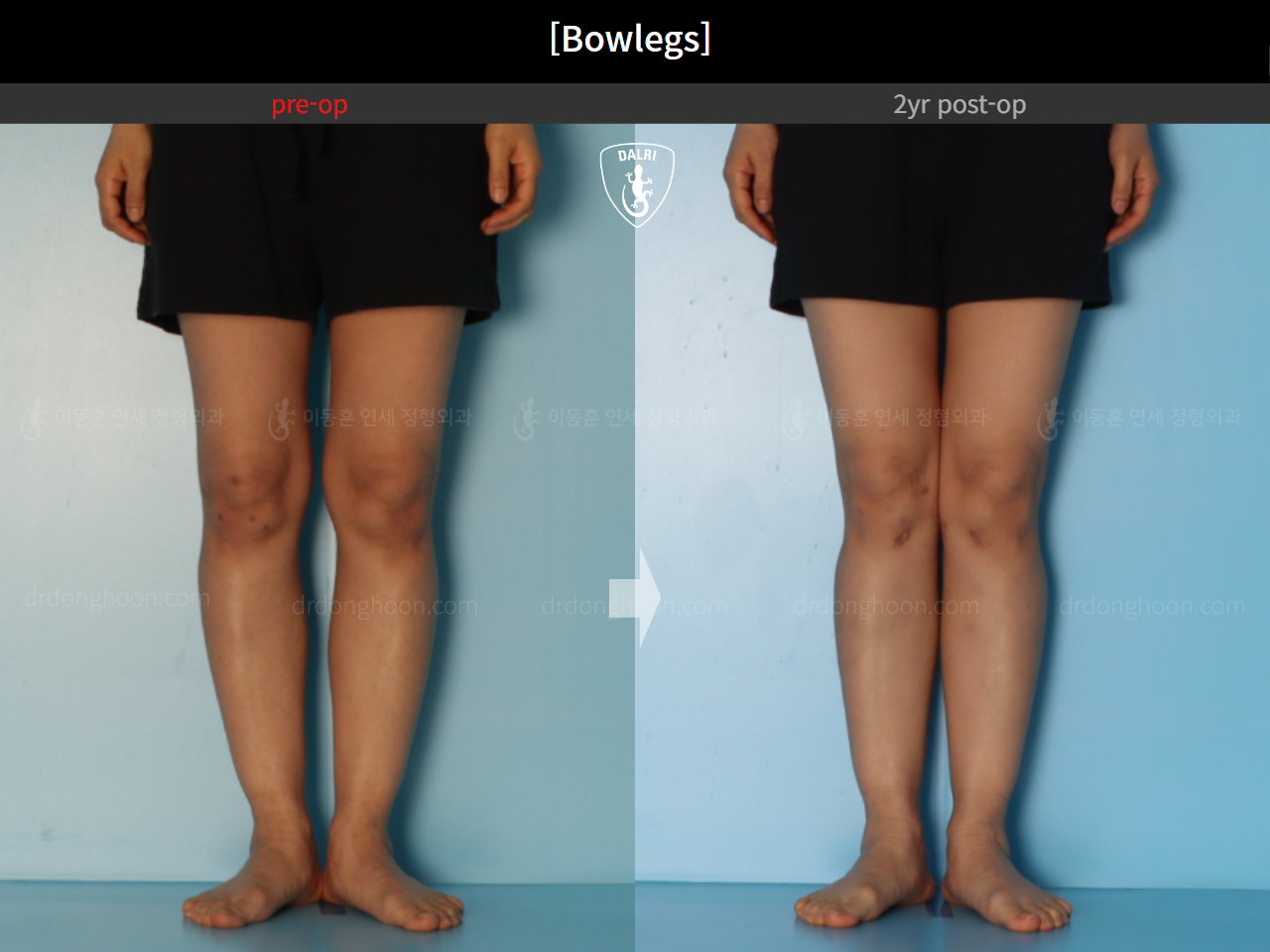 Before and after adult bowlegs, case 20942169, image 7, Dr. Donghoon institute (DALRI)