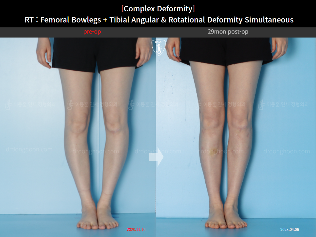 Before and after adult bowlegs, case 14771490, image 6, Dr. Donghoon institute (DALRI)