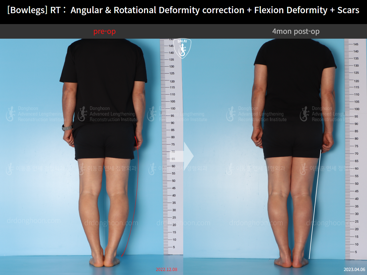 Before and after adult bowlegs, case 14701830, image 3, Dr. Donghoon institute (DALRI)