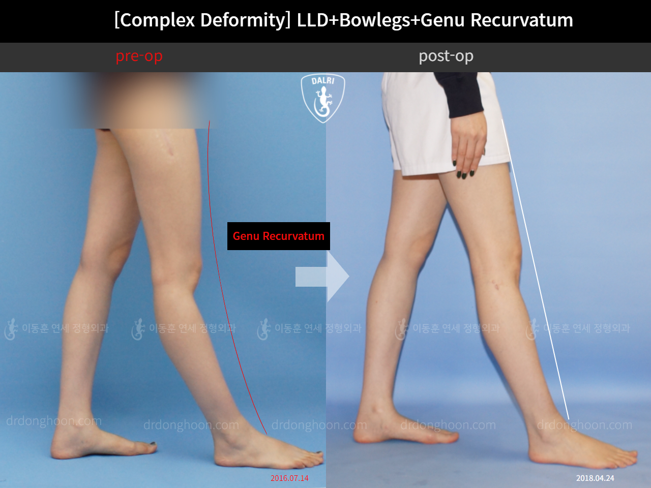 Before and after genu recurvatum, case 11648322, image 4, Dr. Donghoon institute (DALRI)