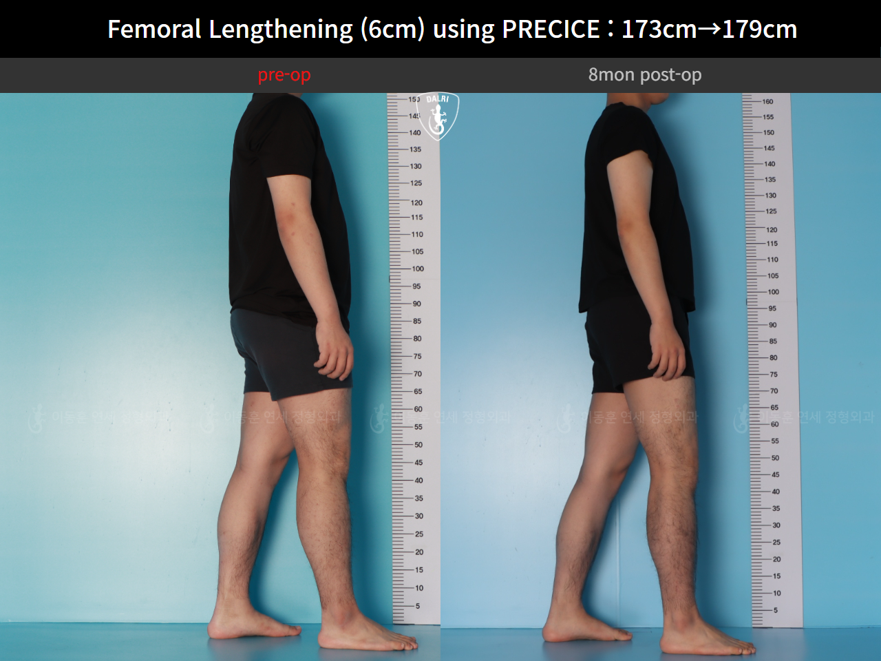 Before and after cll precice, case 89066969, image 3, Dr. Donghoon institute (DALRI)