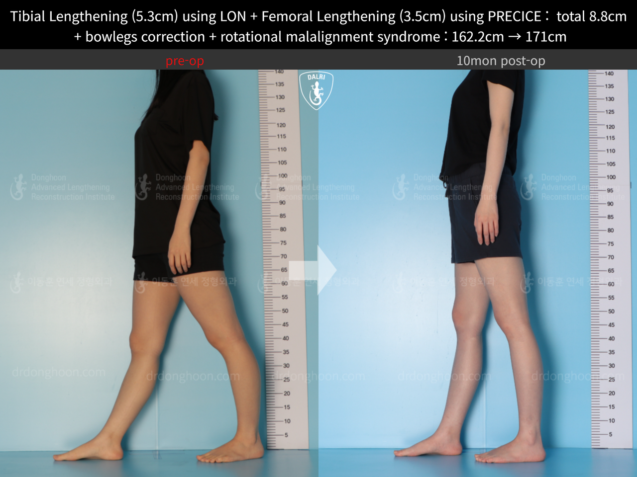 Before and after cll + deformity correction, case 13127167, image 9, Dr. Donghoon institute (DALRI)
