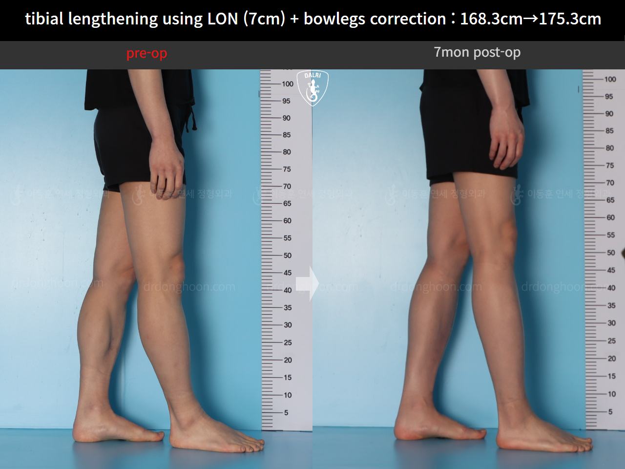 Before and after cll + deformity correction, case 21918246, image 10, Dr. Donghoon institute (DALRI)