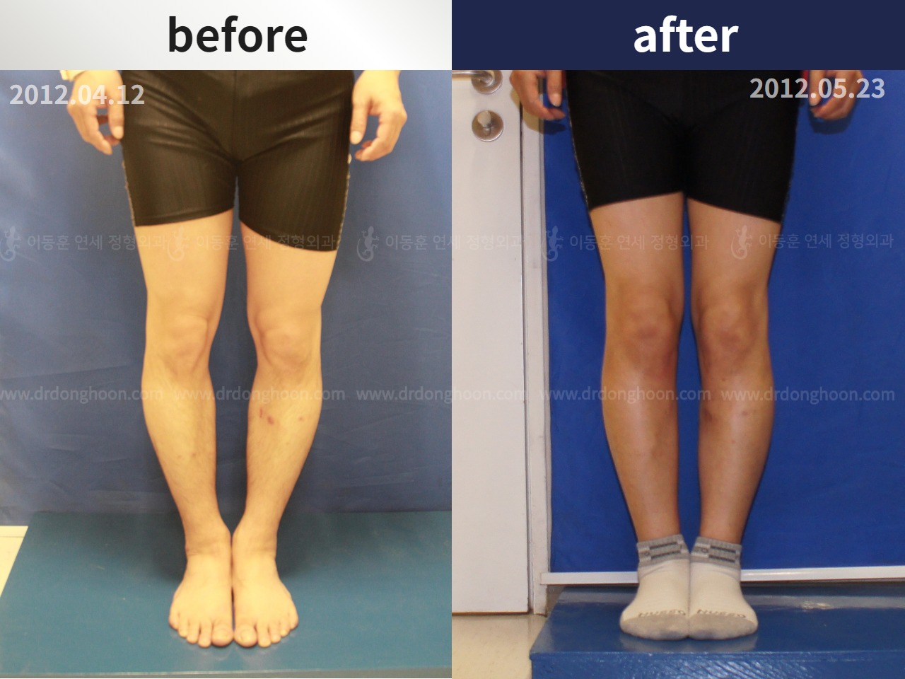 Before and after adult bowlegs, case 4311117, image 1, Dr. Donghoon institute (DALRI)