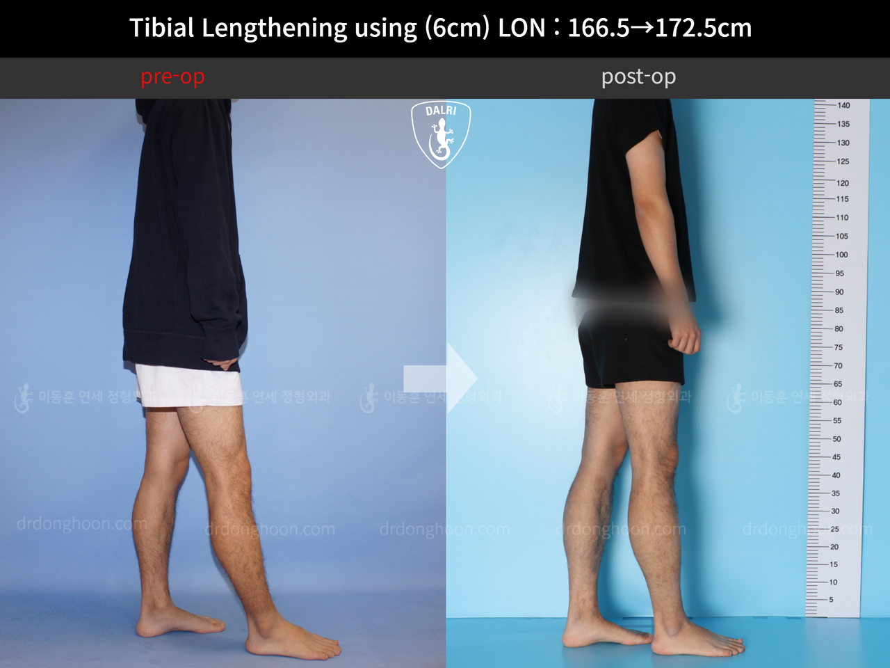 Before and after cll lon, case 11980239, image 3, Dr. Donghoon institute (DALRI)