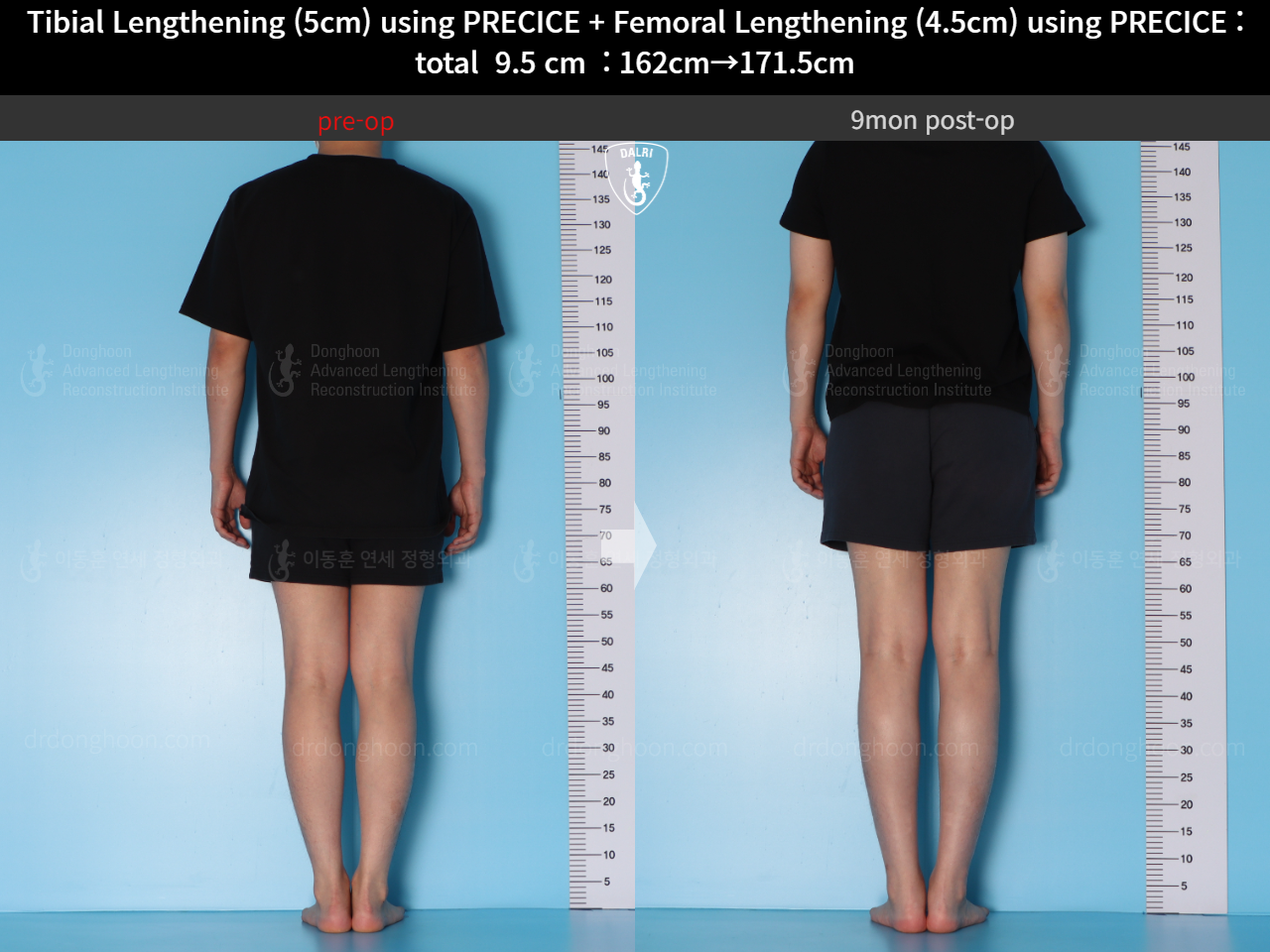 Before and after cll precice, case 15344460, image 3, Dr. Donghoon institute (DALRI)