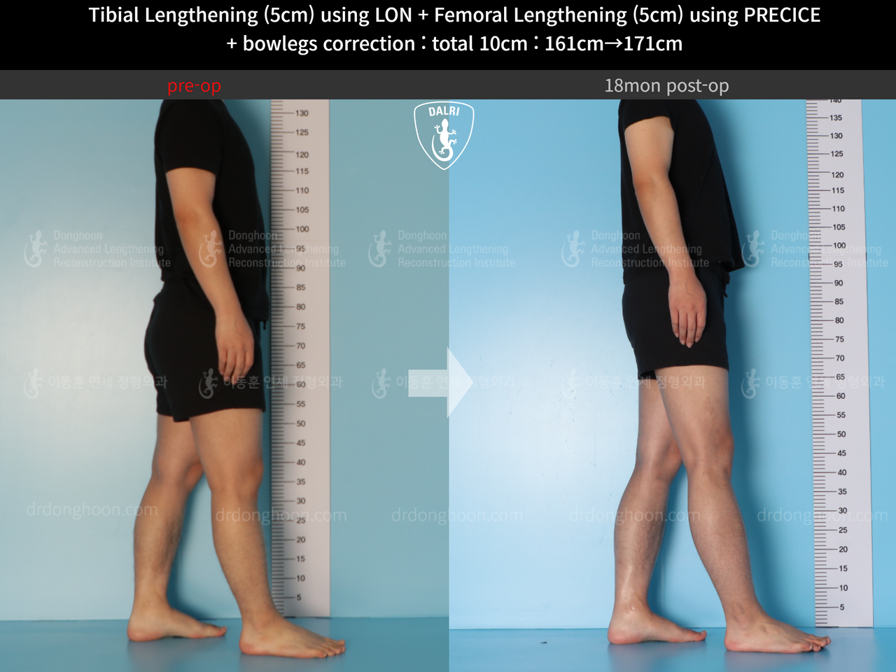 Before and after cll + deformity correction, case 13660857, image 6, Dr. Donghoon institute (DALRI)