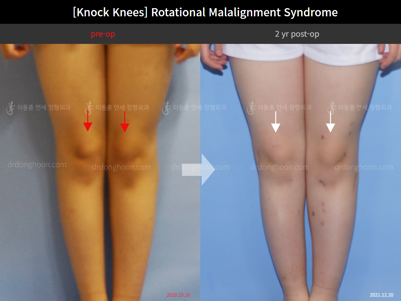 Before and after adult knock knees, case 9232717, image 6, Dr. Donghoon institute (DALRI)