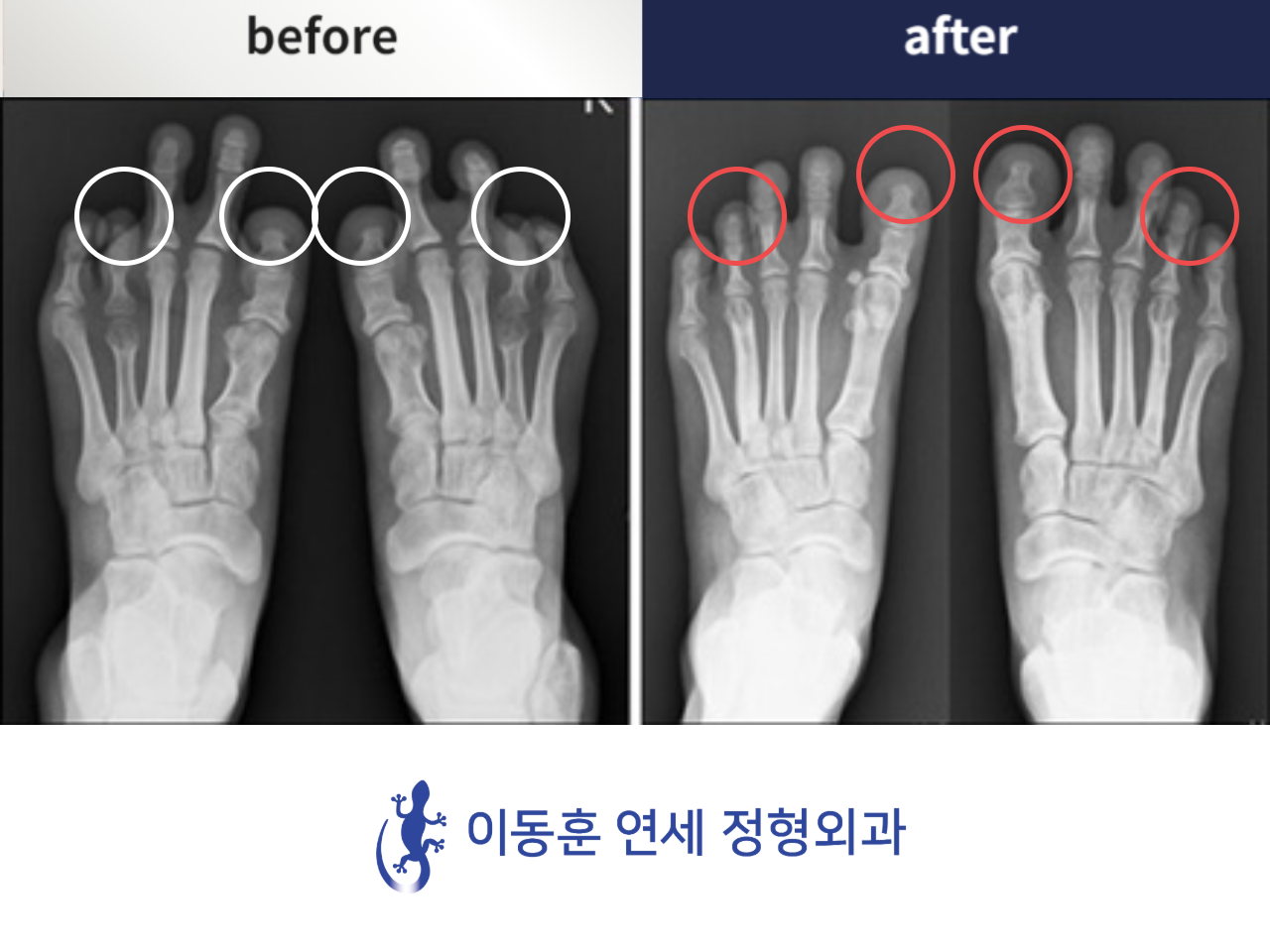 Before and after brachymetatarsia, case 4248992, image 1, Dr. Donghoon institute (DALRI)