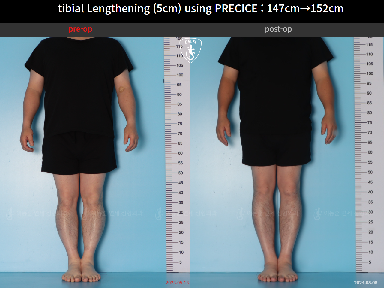 Before and after cll precice, case 89098588, image 1, Dr. Donghoon institute (DALRI)