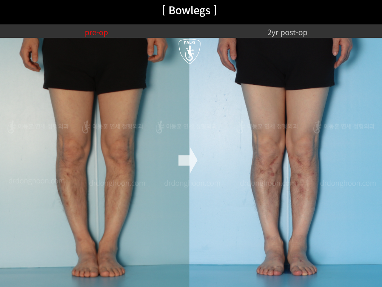 Before and after adult bowlegs, case 14445187, image 3, Dr. Donghoon institute (DALRI)