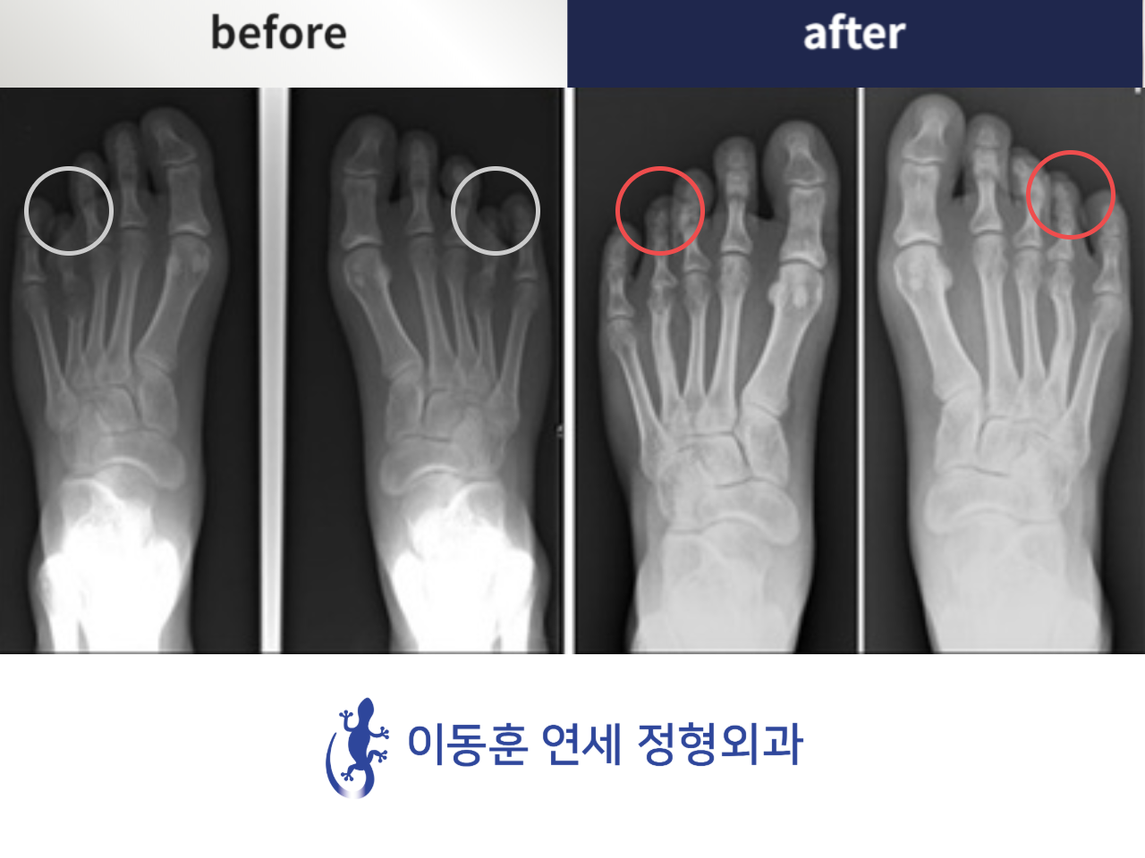 Before and after brachymetatarsia, case 4249012, image 1, Dr. Donghoon institute (DALRI)