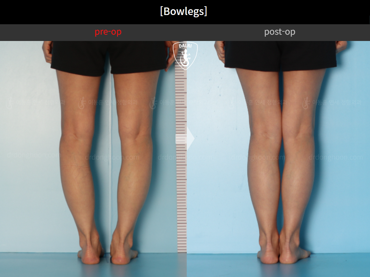 Before and after adult bowlegs, case 17463322, image 6, Dr. Donghoon institute (DALRI)