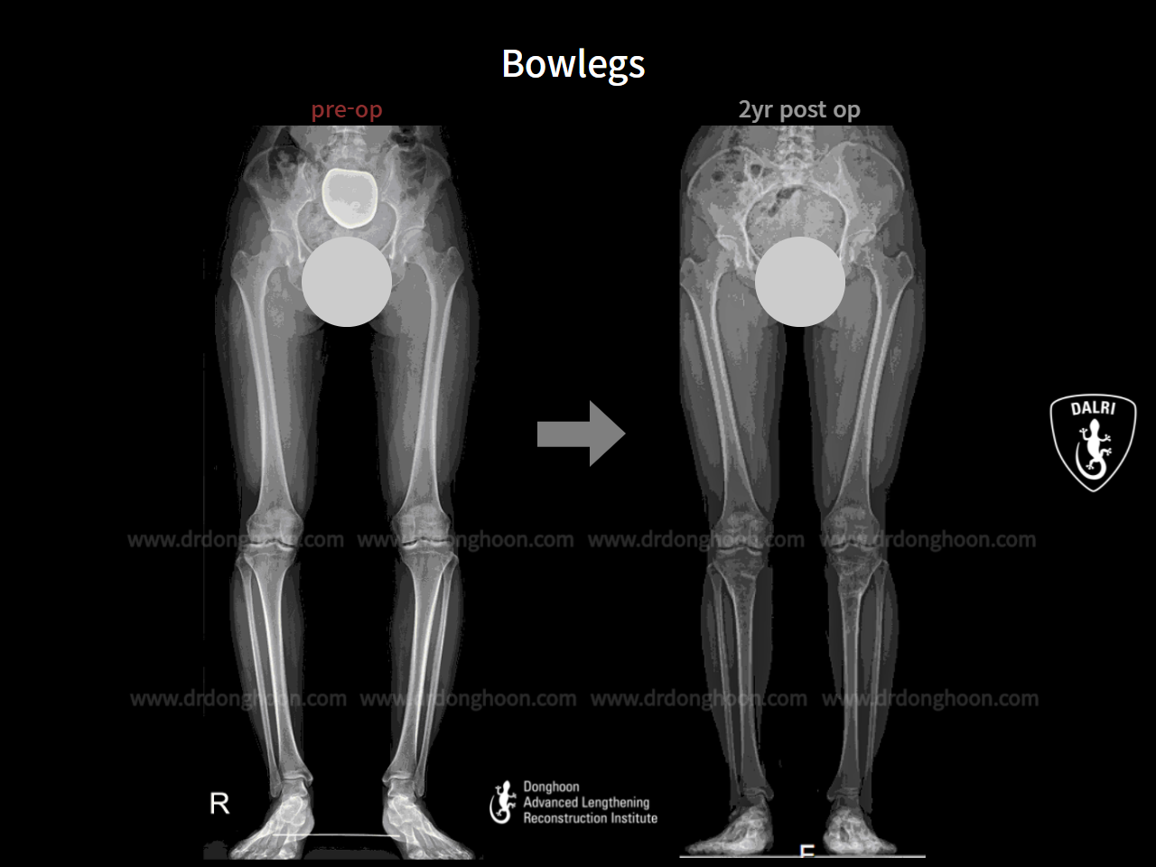 Before and after adult bowlegs, case 7651607, image 9, Dr. Donghoon institute (DALRI)