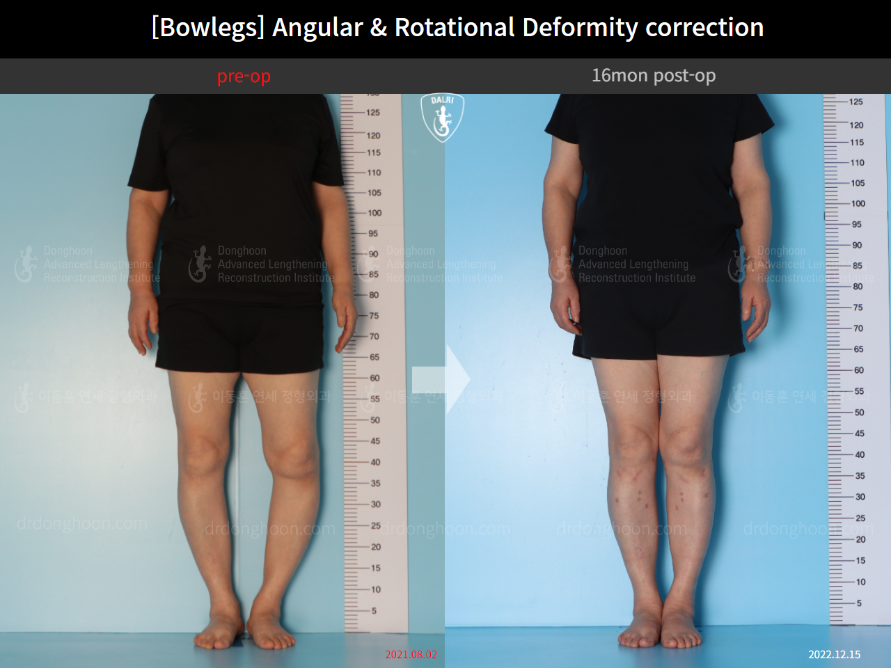 Before and after adult bowlegs, case 14637299, image 1, Dr. Donghoon institute (DALRI)